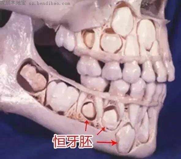 所以,不光恒牙需要做窝沟封闭,乳磨牙也应该利用它来预防龋齿.