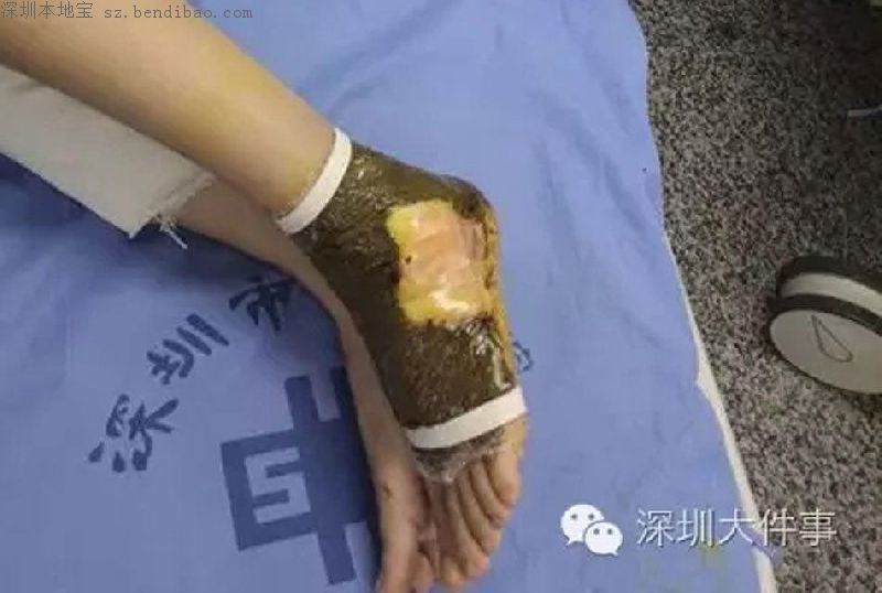 深圳民警吸蛇毒救人 舌头与手臂发麻