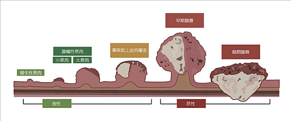 2022温州瑞安湖岭镇卫生院结直肠癌免费筛查时间 对象