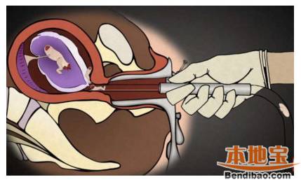 堕胎手术细节曝光 这4种手术令人寒颤